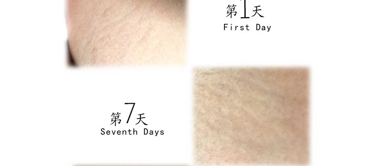 走魚(yú)妊娠紋修復(fù)套裝2_01.jpg